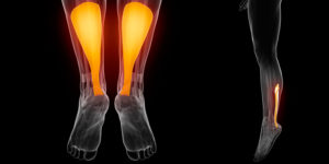 Akilleskipu ja akillesvaiva ovat liikuntapiireissä tuttua. Nykyinen käsitys hoidosta on hyvin erilainen kuin 10 vuotta sitten.